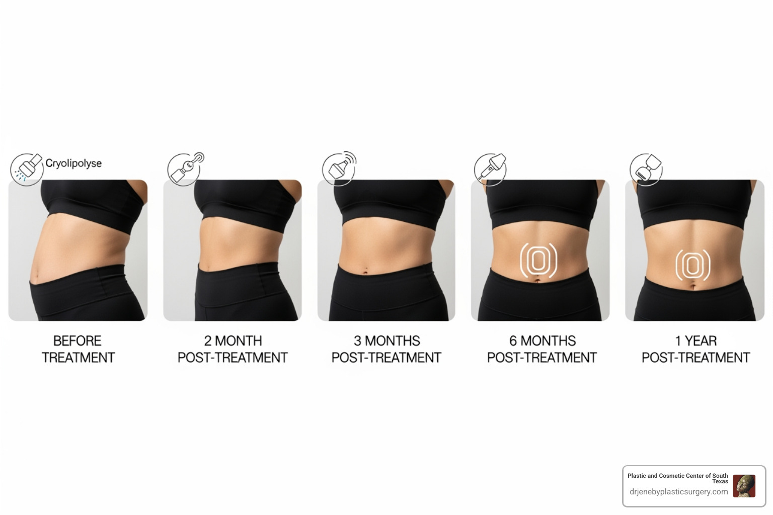 non surgical fat removal results timeline - non surgical fat removal non surgical fat removal results timeline - non surgical fat removal