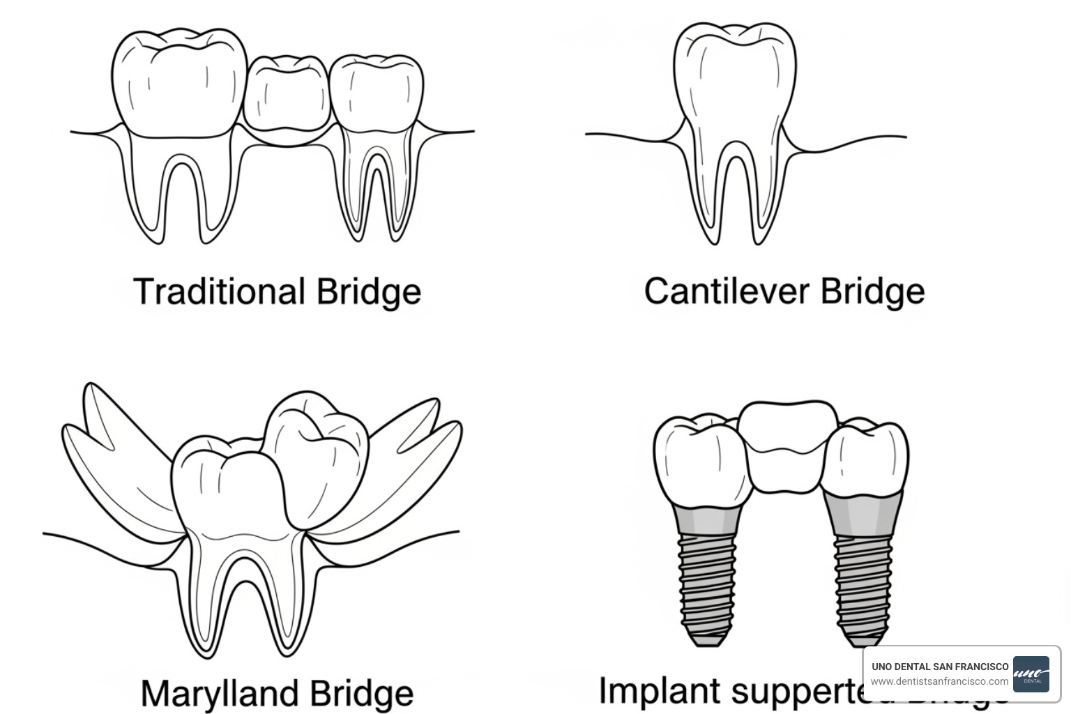 diagrams of Traditional, Cantilever, Maryland, and Implant-supported bridges - dental bridge San Francisco diagrams of Traditional, Cantilever, Maryland, and Implant-supported bridges - dental bridge San Francisco