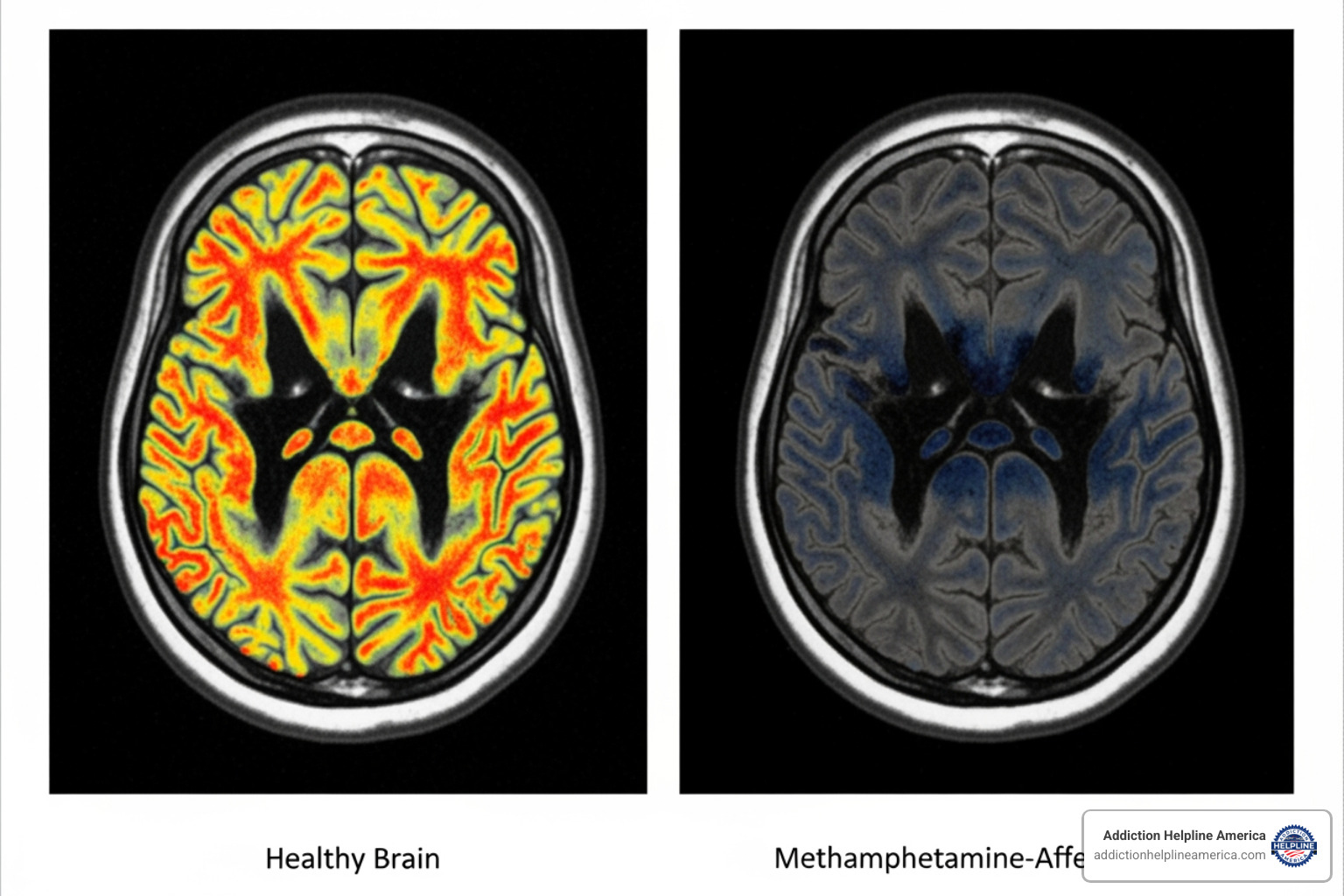 contrast between healthy brain scan and one affected by long-term meth use - Inpatient meth rehab