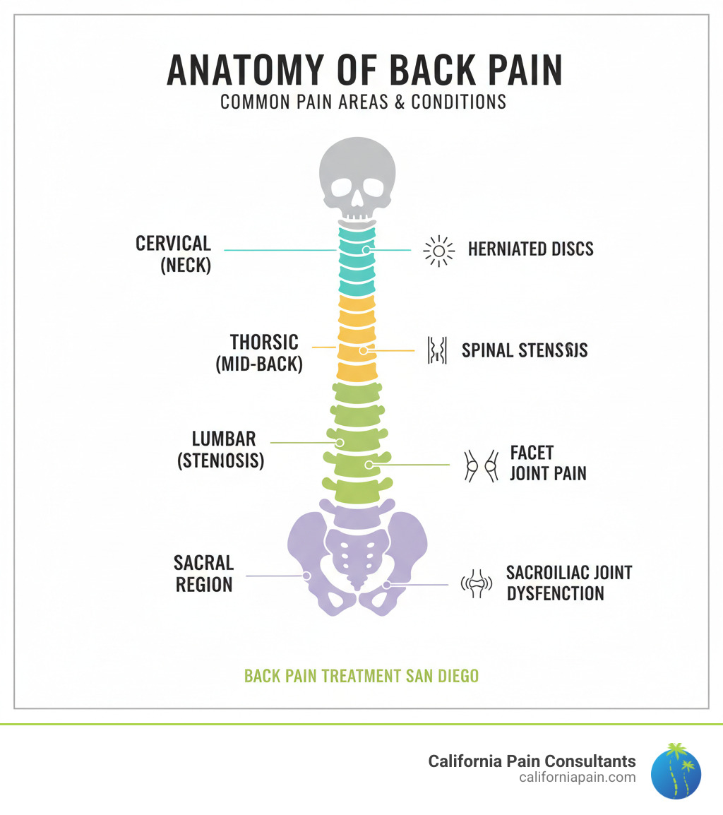 Infographic showing the anatomy of the spine with common back pain areas highlighted, including cervical (neck), thoracic (mid-back), lumbar (lower back), and sacral regions, with labels for common conditions like herniated discs, spinal stenosis, facet joint pain, and sacroiliac joint dysfunction - back pain treatment San Diego infographic 