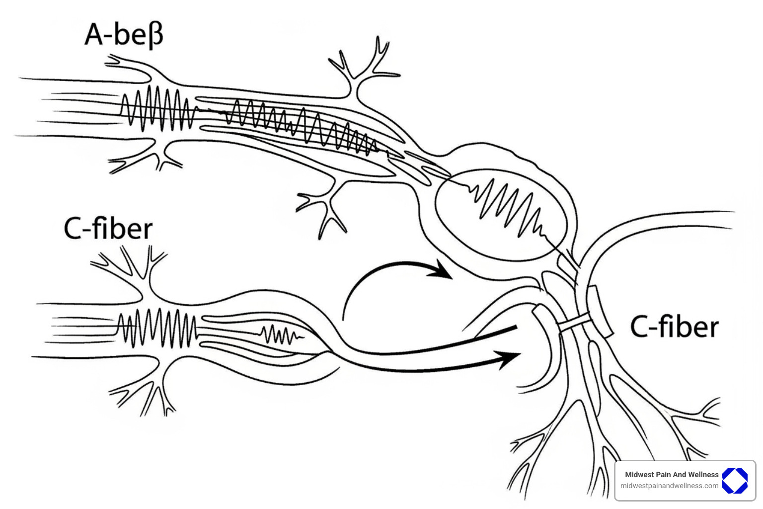 Diagram illustrating the Gate Control Theory of pain, showing how electrical stimulation of large A-beta nerve fibers can close the "gate" in the spinal cord, preventing pain signals carried by smaller C-fibers from reaching the brain. - Peripheral nerve stimulation