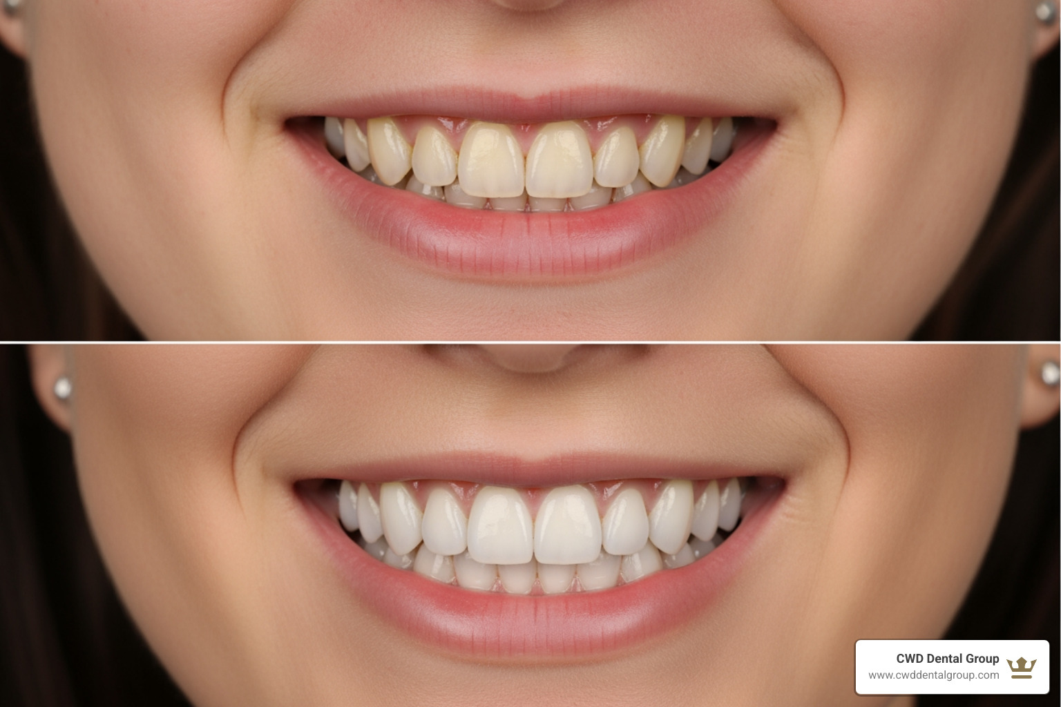 before after veneers - Porcelain veneers Tallahassee before after veneers - Porcelain veneers Tallahassee