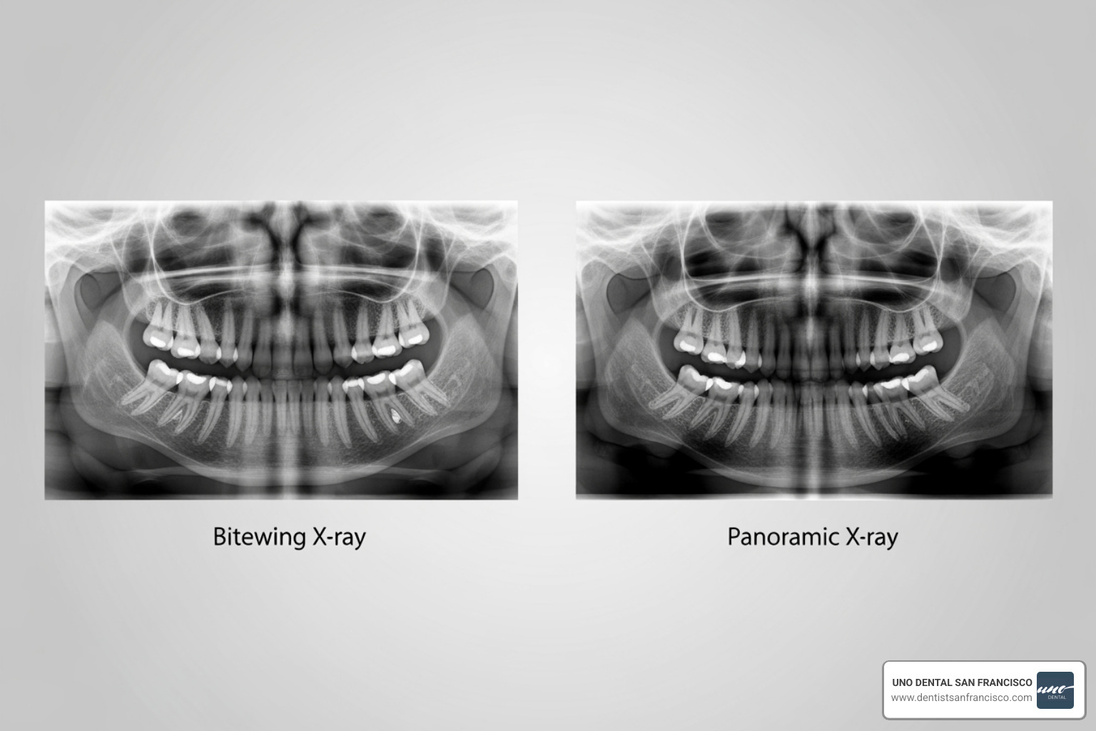 bitewing vs panoramic X-ray - pediatric dental X-rays bitewing vs panoramic X-ray - pediatric dental X-rays