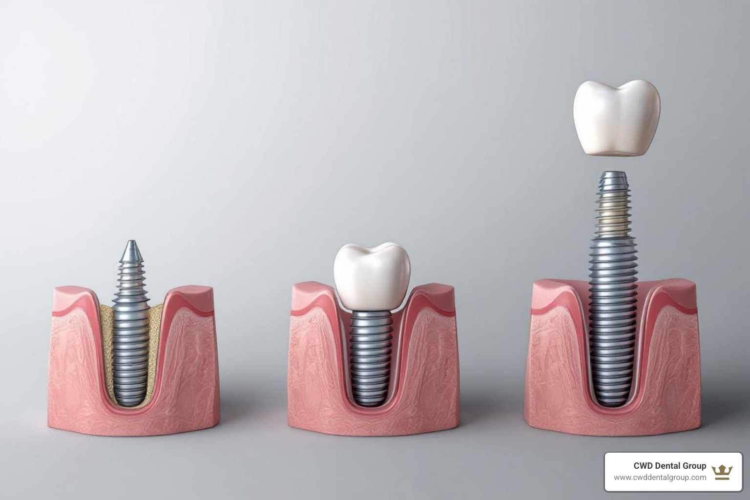 sequential images showing the dental implant process from initial placement to final crown - Implant dentist Tallahassee