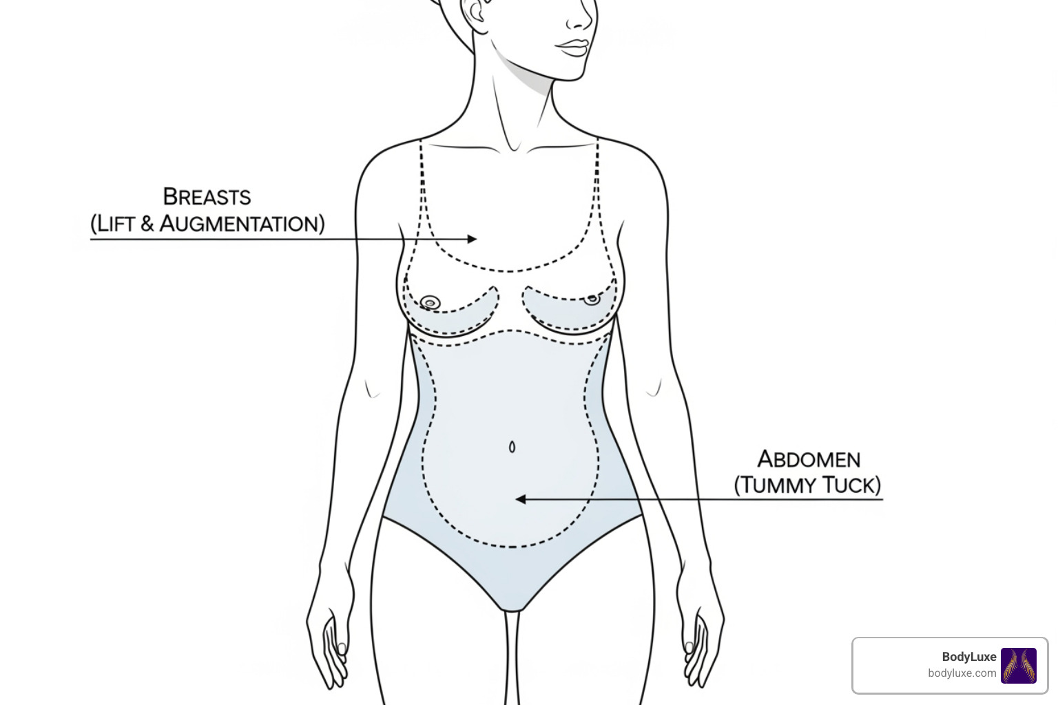 diagram showing common mommy makeover procedure areas (breasts, abdomen) - awake mommy makeover diagram showing common mommy makeover procedure areas (breasts, abdomen) - awake mommy makeover