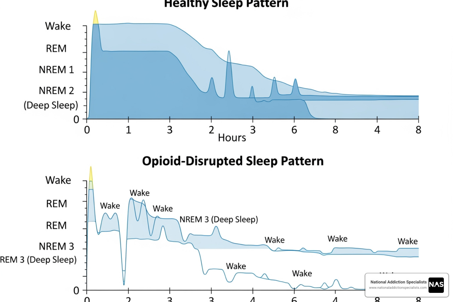 Hypnogram illustrating sleep architecture disruptions caused by opioids - suboxone and sleep
