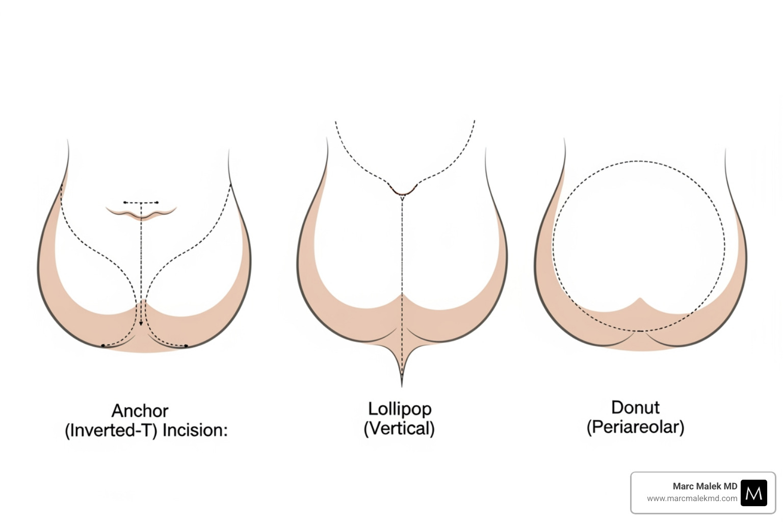 diagram illustrating the anchor, lollipop, and donut incision patterns - breast reduction scar diagram illustrating the anchor, lollipop, and donut incision patterns - breast reduction scar