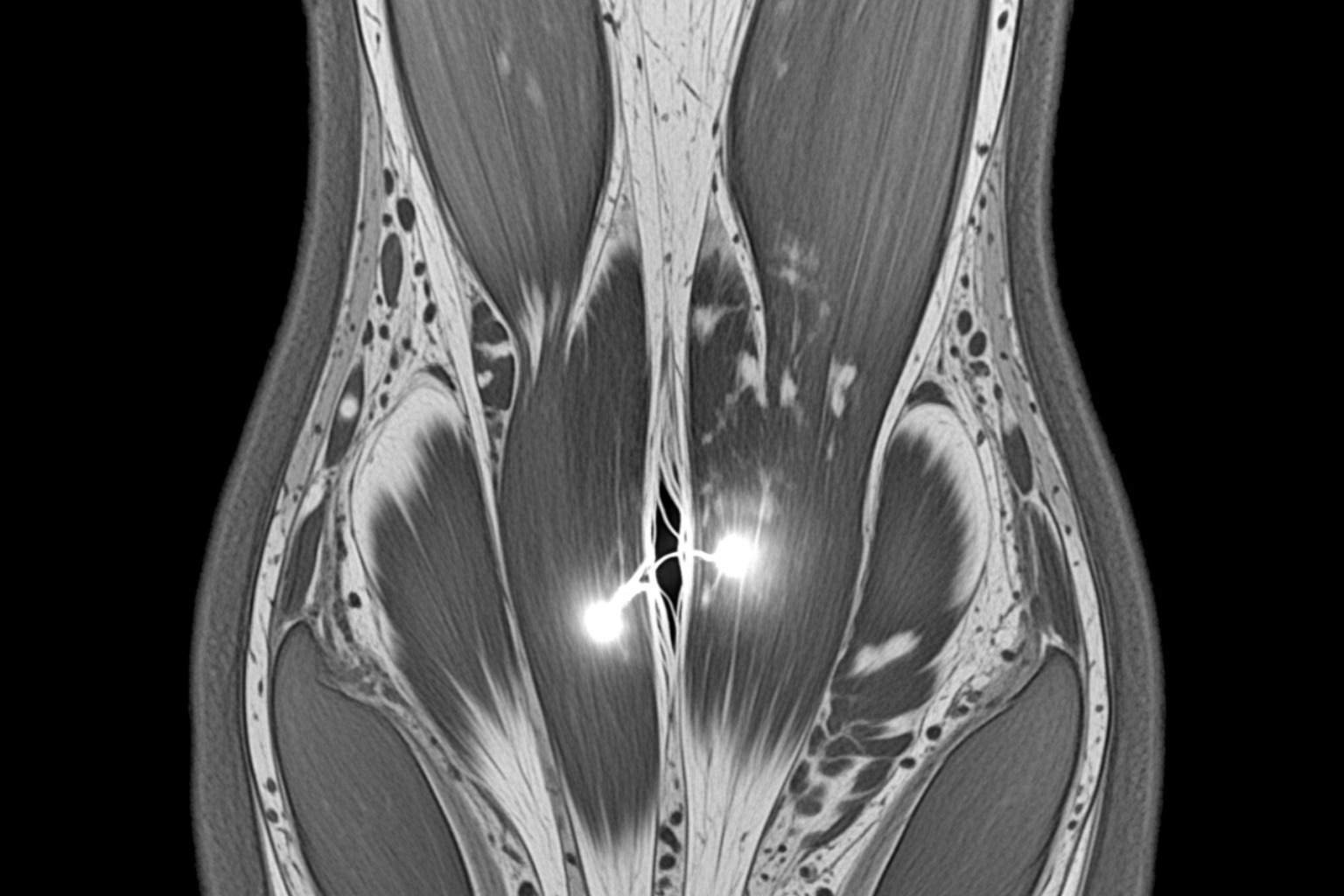 MRI scan showing a clear hamstring tear with inflammation and fluid accumulation, highlighting the injured area in detail - recovery time hamstring tear