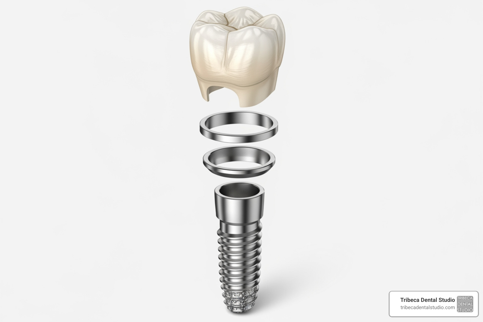 illustration of the components of a dental implant (post, abutment, crown) - Immediate dental implants NYC
