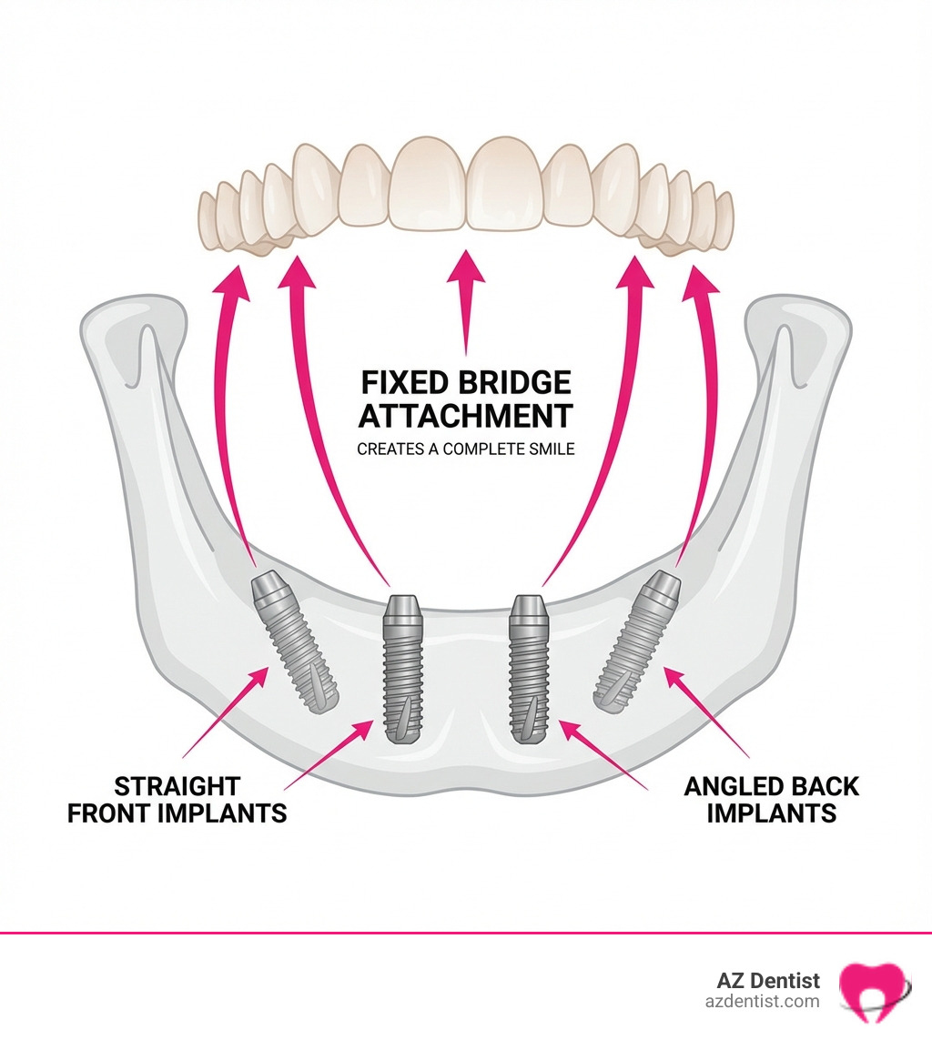 Infographic showing four titanium implants placed at strategic angles in the jawbone supporting a full arch of fixed prosthetic teeth, with labels indicating the two straight front implants and two angled back implants, plus arrows showing how the fixed bridge attaches to create a complete smile - Glendale all on 4 infographic 