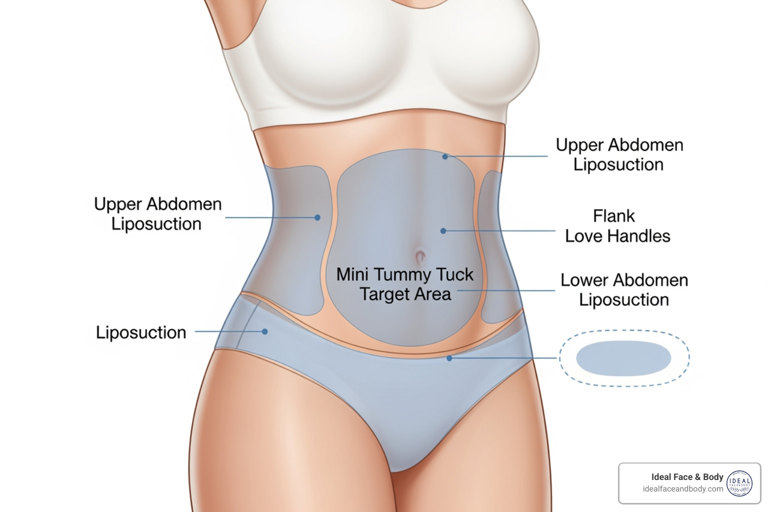 target areas for a mini tummy tuck versus abdominal liposuction - cost of mini tummy tuck and liposuction target areas for a mini tummy tuck versus abdominal liposuction - cost of mini tummy tuck and liposuction