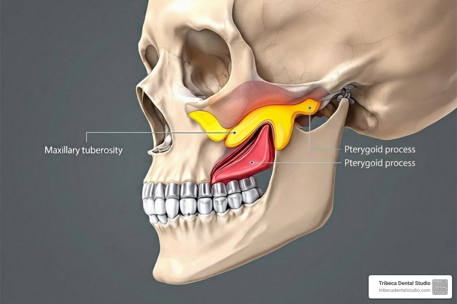 Key bony landmarks for pterygoid implant placement - pterygoid implants anatomy