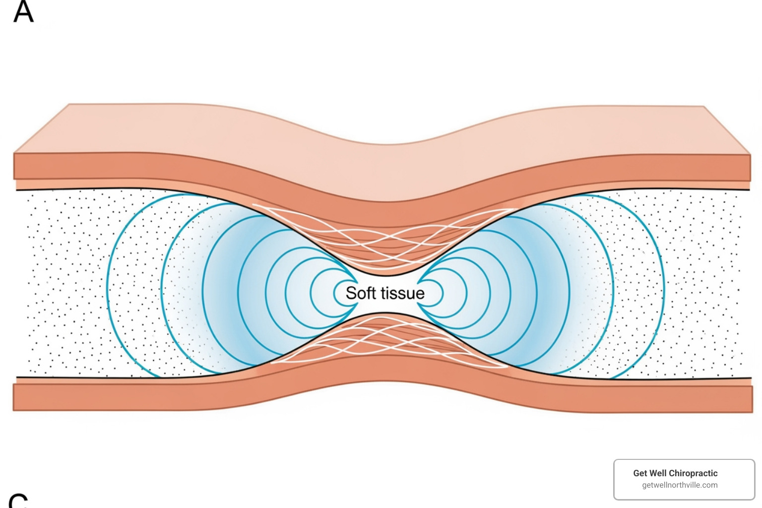diagram showing acoustic waves penetrating soft tissue - myact therapy