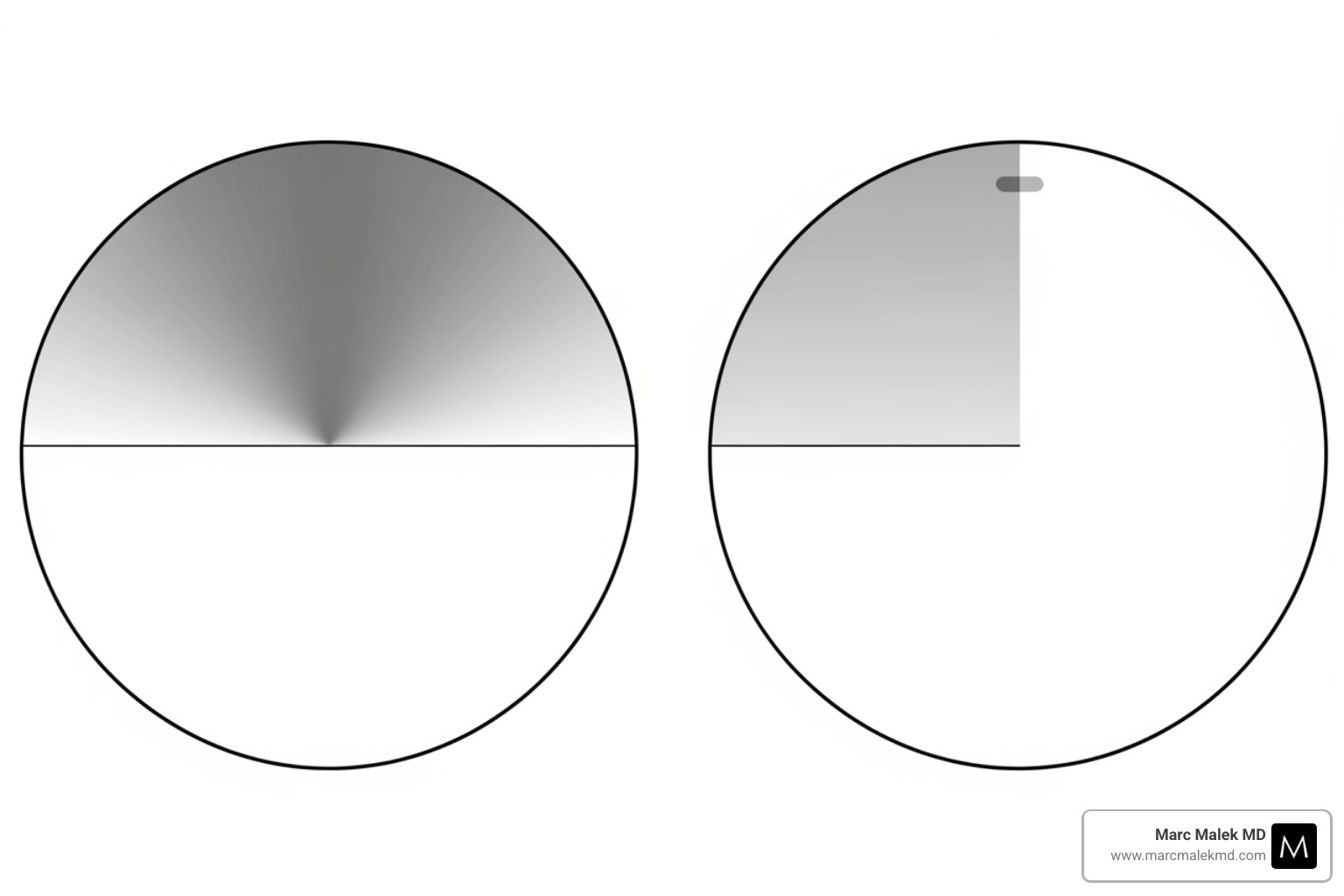 Image of a sample visual field test result, showing a shaded area indicating vision obstruction in the upper field, and a clear area after simulation of eyelid lift. - how to get insurance to pay for eyelid surgery Image of a sample visual field test result, showing a shaded area indicating vision obstruction in the upper field, and a clear area after simulation of eyelid lift. - how to get insurance to pay for eyelid surgery