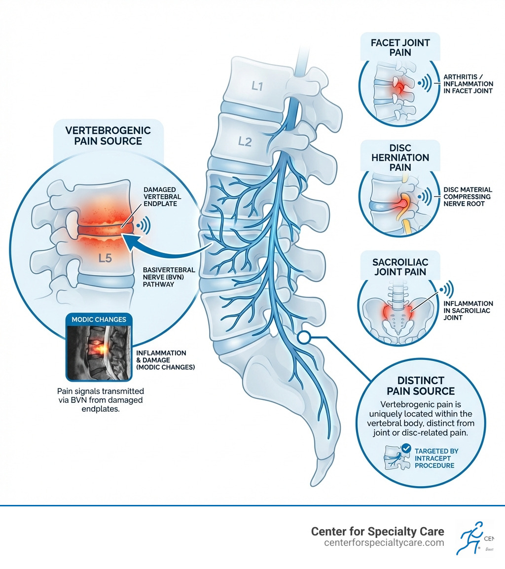 Infographic showing the basivertebral nerve pathway within vertebral bodies and how vertebrogenic pain differs from facet joint pain, disc herniation pain, and sacroiliac joint pain, with labeled anatomy of the lumbar spine highlighting vertebral endplates and the location of Modic changes - intracept infographic 