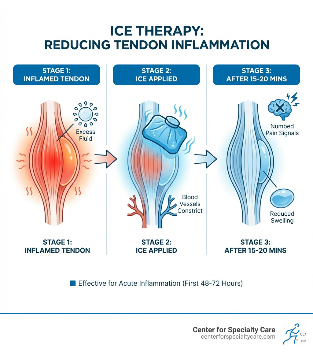 Infographic showing ice application reducing inflammation in three stages: 1) Inflamed tendon with excess fluid and heat, 2) Ice pack applied causing blood vessels to constrict, 3) Reduced swelling and numbed pain signals after 15-20 minutes of treatment - is ice good for tendonitis infographic 