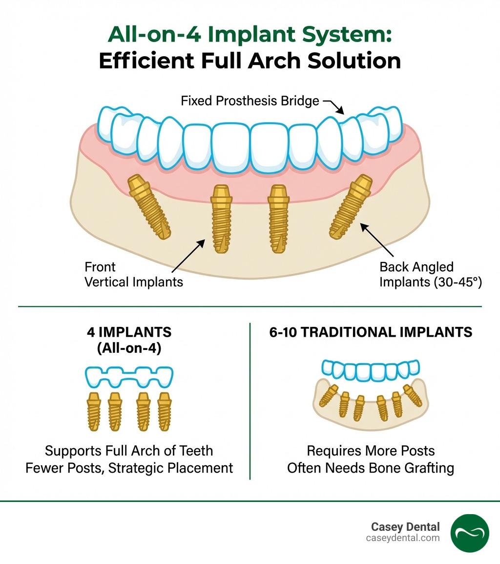 infographic showing cross-section of jaw with 4 angled implants supporting a full arch of teeth, labeled with front vertical implants, back angled implants at 30-45 degrees, fixed prosthesis bridge, and comparison showing 4 implants vs 6-10 traditional implants - all on 4 implants infographic 