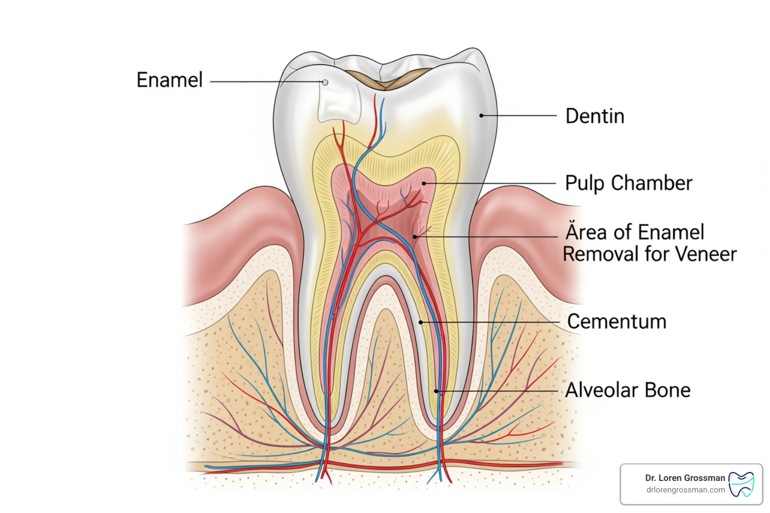A diagram showing the minimal amount of enamel removed for a veneer - dental veneers procedure A diagram showing the minimal amount of enamel removed for a veneer - dental veneers procedure