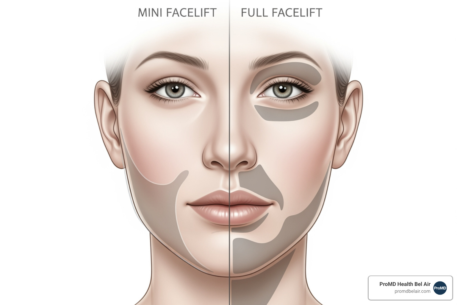 Mini vs. Full Facelift Areas - how much facelift Mini vs. Full Facelift Areas - how much facelift
