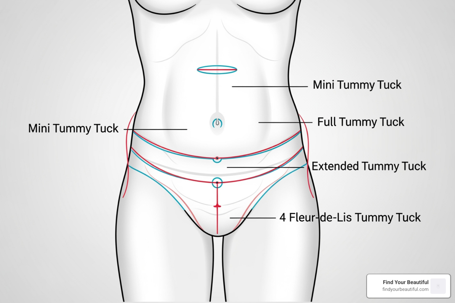 diagram showing the different tummy tuck incision types (mini, full, extended, fleur-de-lis) on a torso - tummy tuck scars