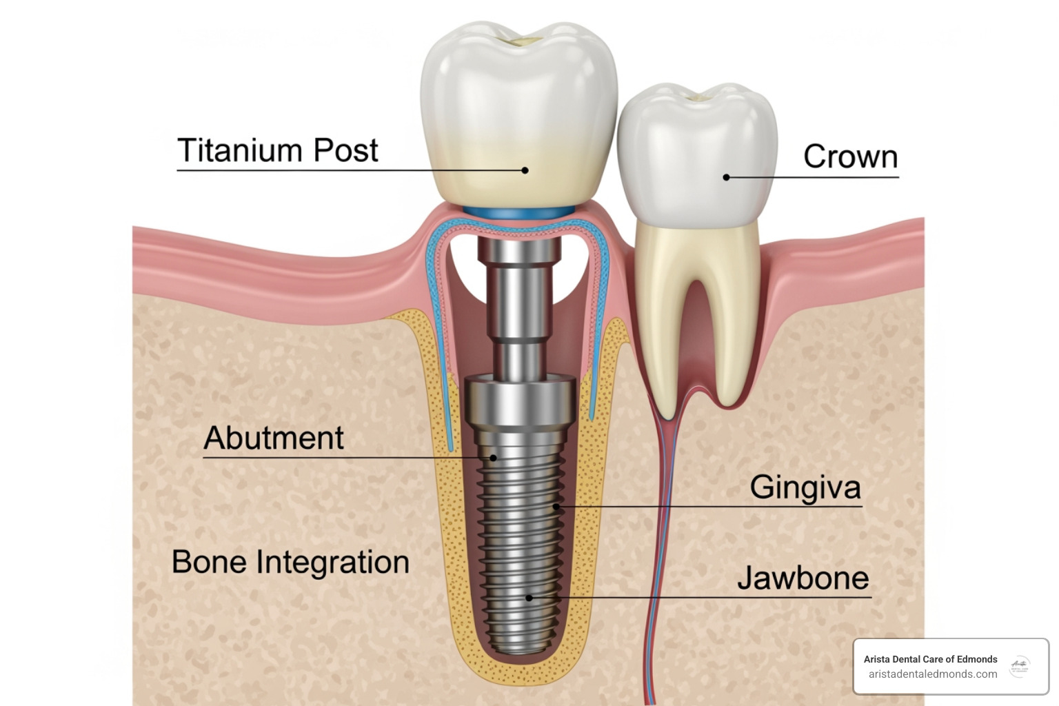 A detailed illustration of a single dental implant, showing the titanium post, abutment, and crown integrated into the jawbone. - edmonds family dentistry edmonds wa