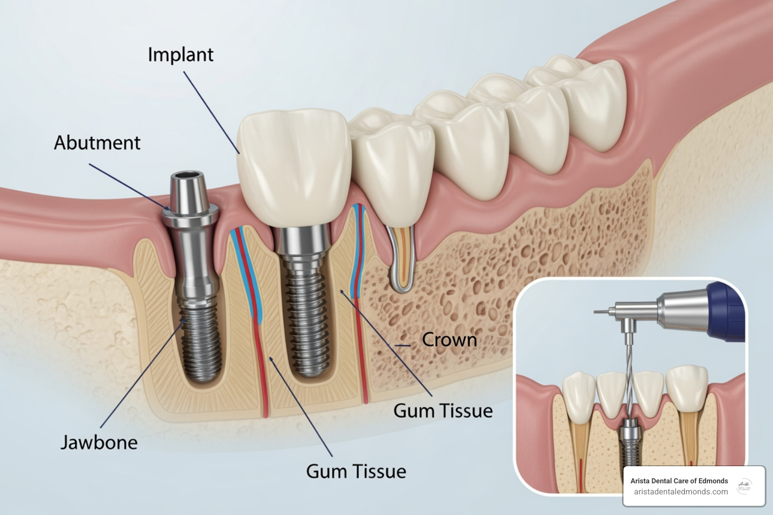 Diagram illustrating the process of osseointegration, where a dental implant fuses with the jawbone over time - what are dental implants