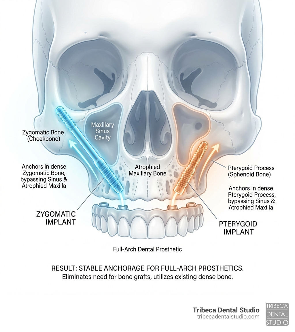 infographic showing zygomatic implants anchoring into the cheekbone and pterygoid implants anchoring into the pterygoid process of the sphenoid bone, with arrows indicating how they bypass the atrophied maxillary bone and sinus cavity to provide stable anchorage for full-arch dental prosthetics - zygomatic and pterygoid implants infographic infographic showing zygomatic implants anchoring into the cheekbone and pterygoid implants anchoring into the pterygoid process of the sphenoid bone, with arrows indicating how they bypass the atrophied maxillary bone and sinus cavity to provide stable anchorage for full-arch dental prosthetics - zygomatic and pterygoid implants infographic