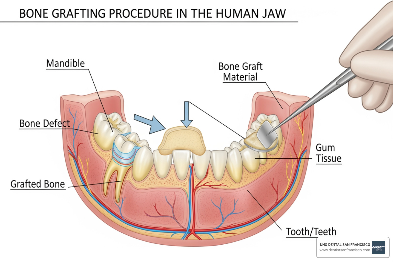 diagram showing a bone grafting procedure - Dental implant cost SF diagram showing a bone grafting procedure - Dental implant cost SF