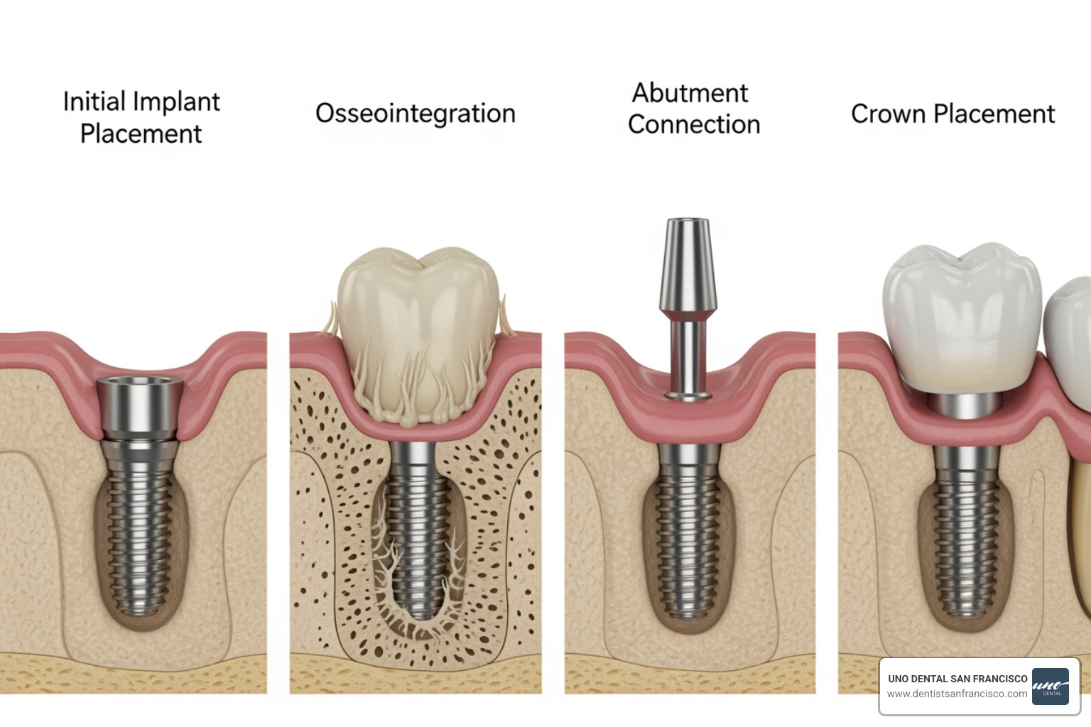 stages of dental implant procedure - Dental implants San Francisco stages of dental implant procedure - Dental implants San Francisco