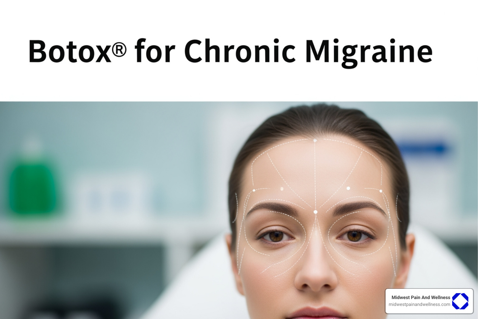 Botox injection sites on head and neck - Botox® for Chronic Migraine