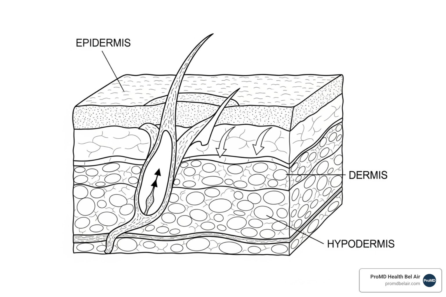 diagram of skin layers—epidermis, dermis, and hypodermis—showing how a chemical peel exfoliates the surface to reveal new cells - wrinkle treatment options diagram of skin layers—epidermis, dermis, and hypodermis—showing how a chemical peel exfoliates the surface to reveal new cells - wrinkle treatment options