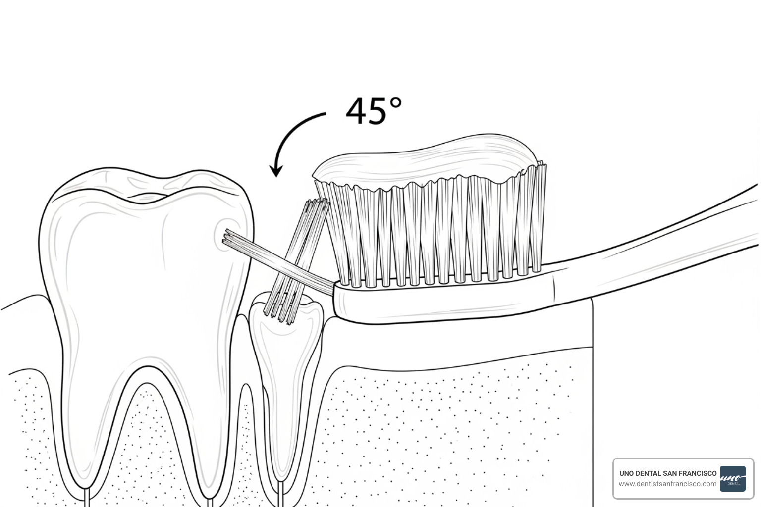 Illustration showing the correct 45-degree angle for toothbrushing, highlighting the bristles cleaning the sulcus (the space between the tooth and gum) Illustration showing the correct 45-degree angle for toothbrushing, highlighting the bristles cleaning the sulcus (the space between the tooth and gum)