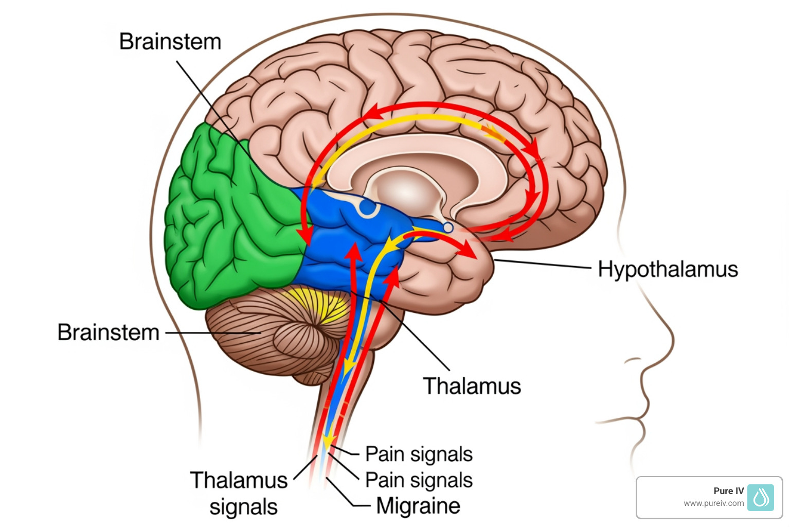 Diagram of the human brain highlighting the brainstem, thalamus, and hypothalamus with arrows showing the pathway of pain signals during a migraine - what causes migraines