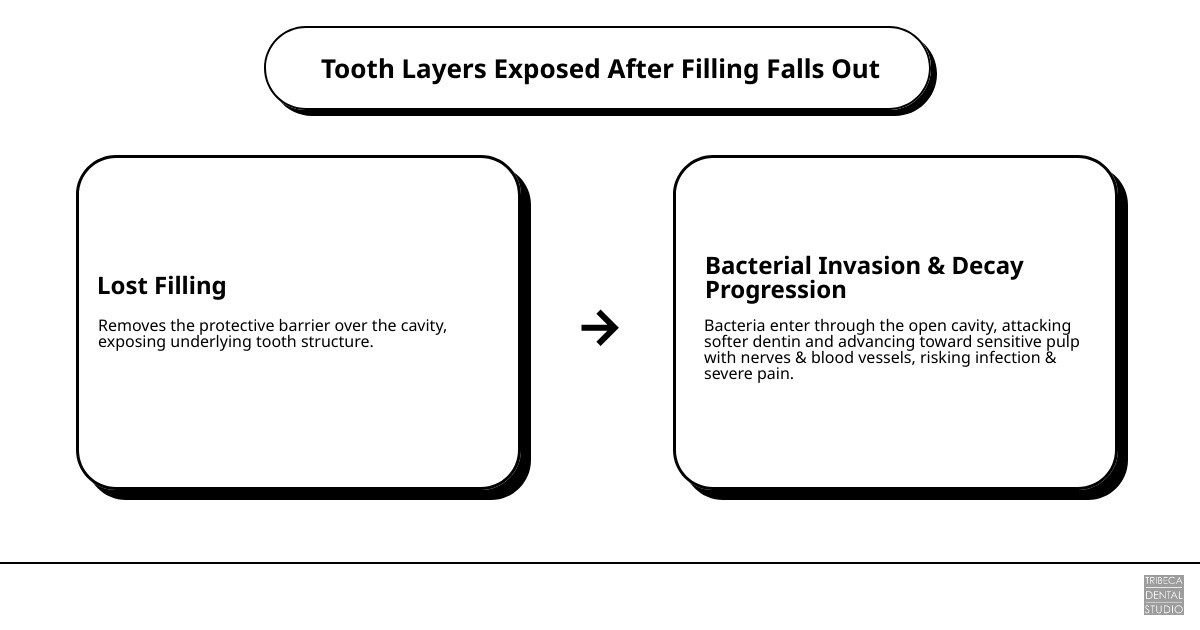 Infographic showing the layers of a tooth exposed after a filling falls out: outer enamel layer, softer dentin layer underneath, inner pulp with nerves and blood vessels at the center, with labels indicating how bacteria can enter through the exposed cavity and progress toward the nerve over time without a protective filling in place - Filling fell out infographic cause_effect_text