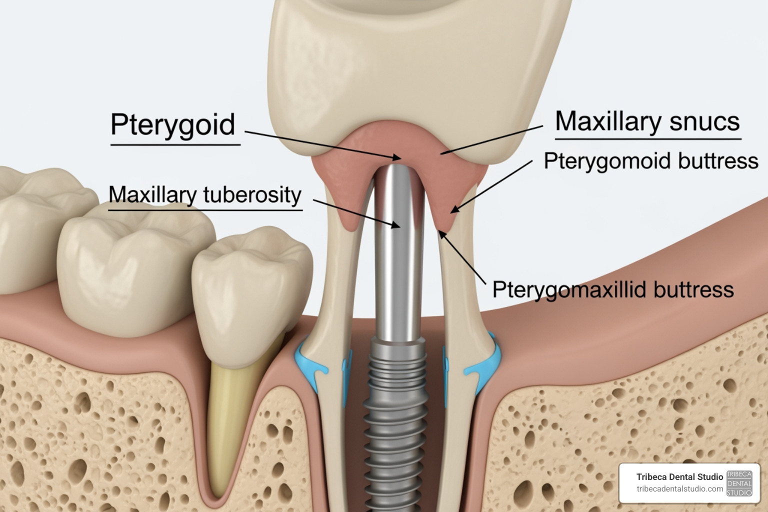 Visualization of the surgical site and the proximity to the maxillary sinus and pterygoid plates - pterygoid implants Visualization of the surgical site and the proximity to the maxillary sinus and pterygoid plates - pterygoid implants
