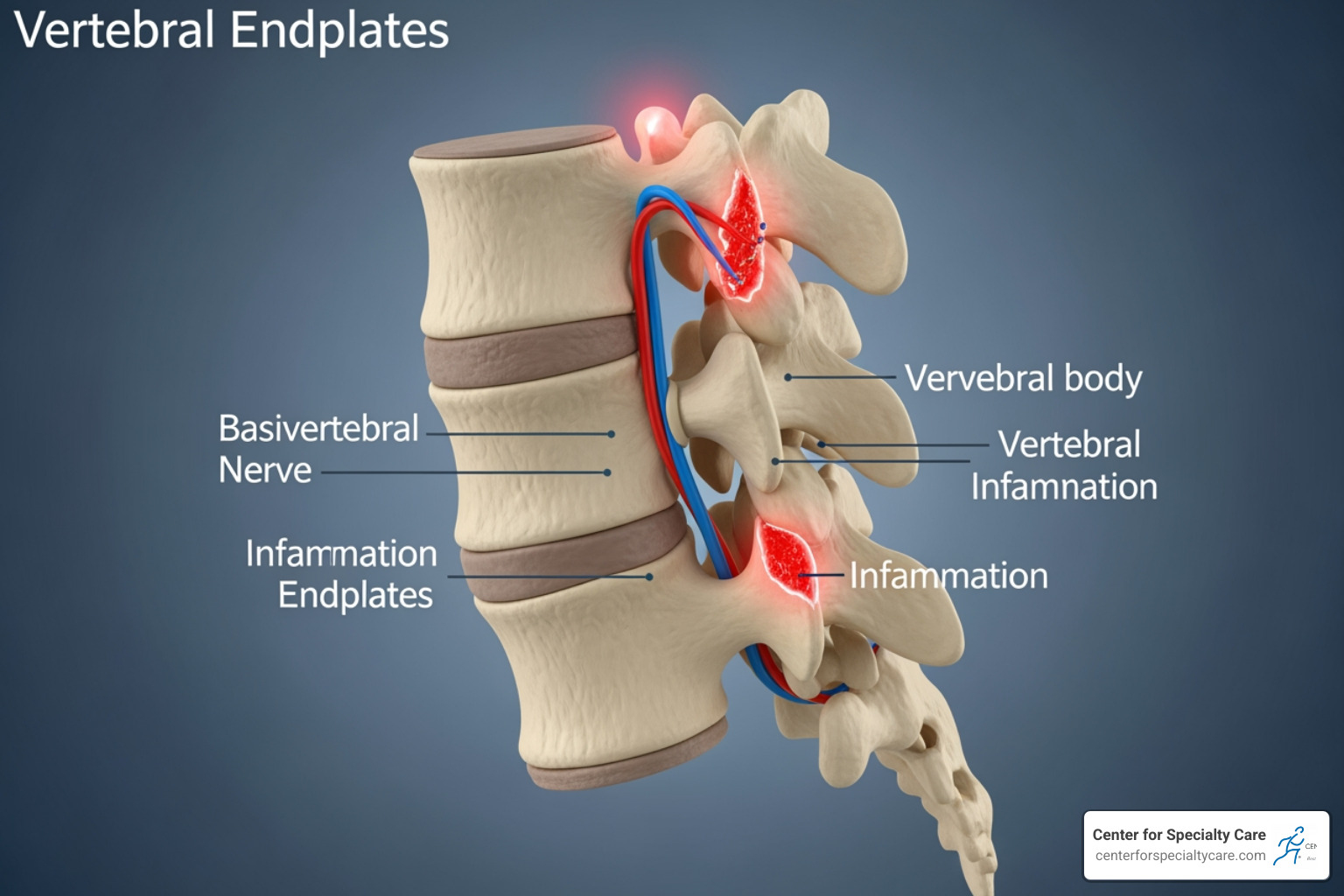 Image showing damaged vertebral endplates and the location of the basivertebral nerve - intracept procedure vs