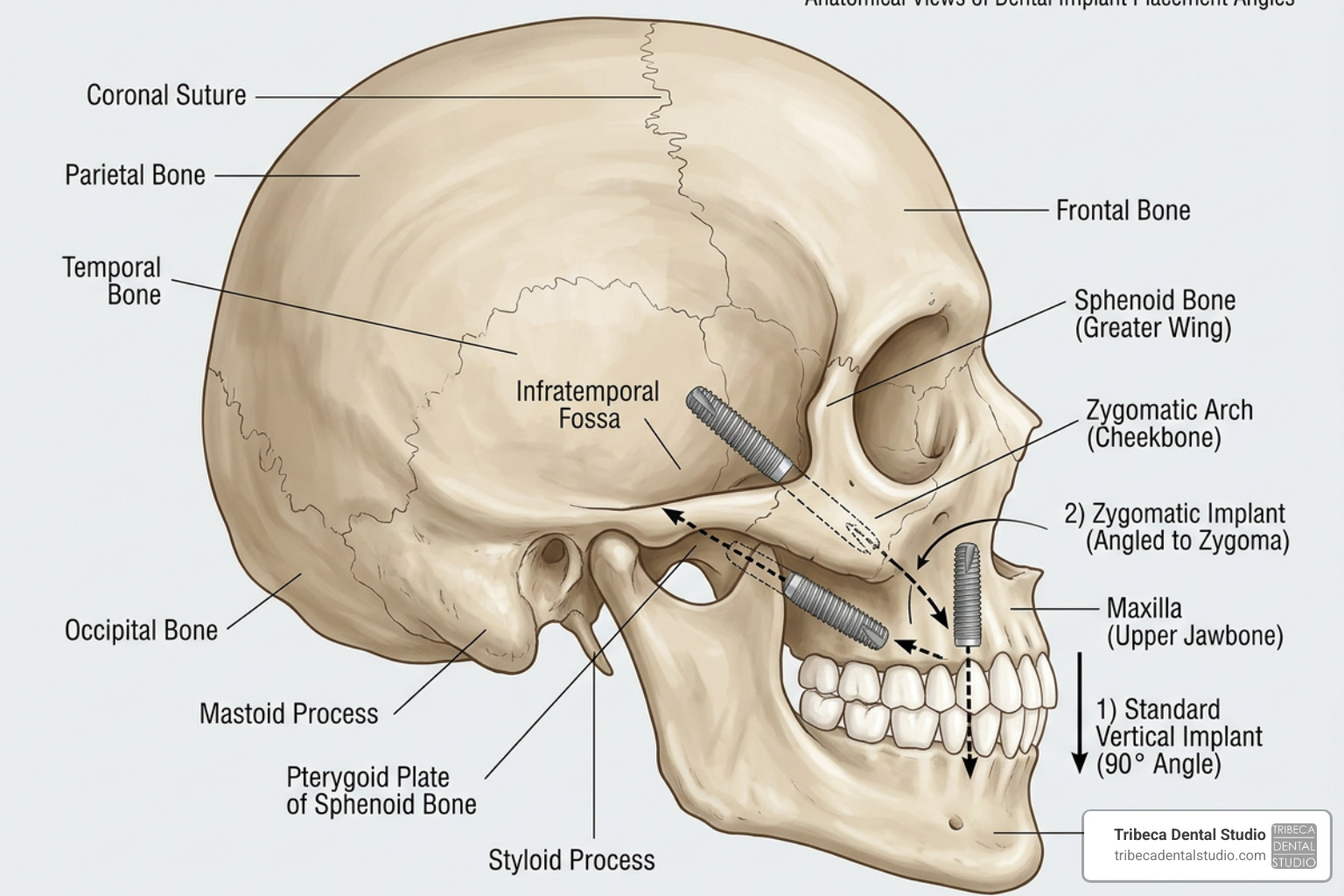 Diagram comparing placement angles of standard, zygomatic, and pterygoid implants - pterygoid implants cost
