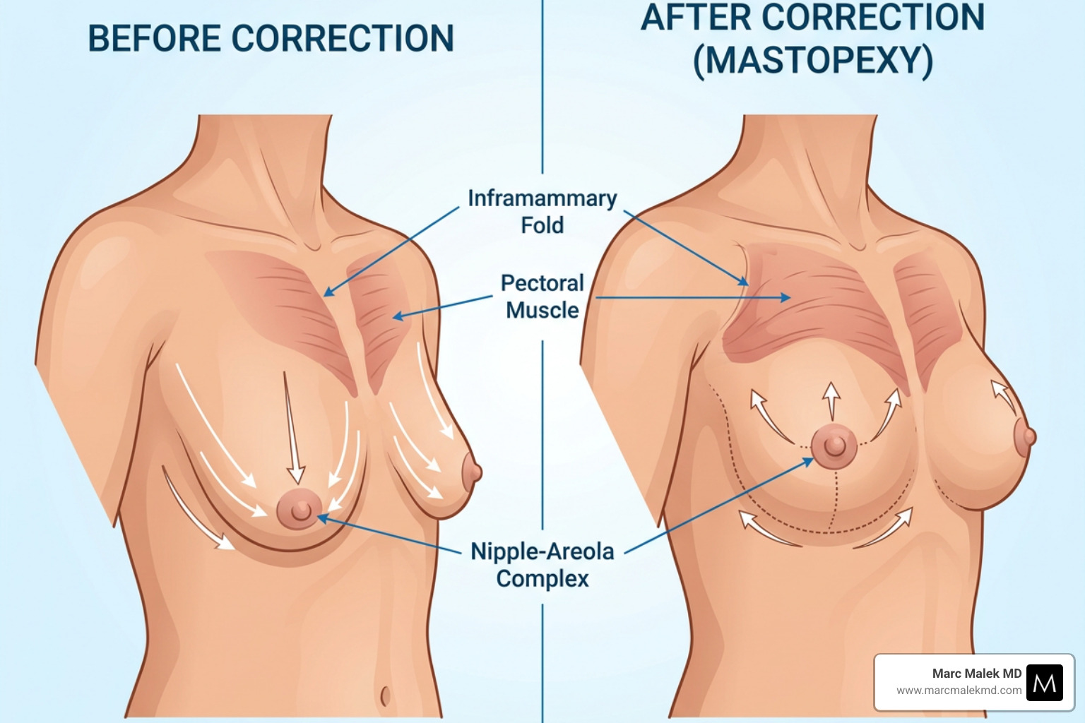 Illustration showing the correction of breast ptosis and nipple repositioning - breast lift arizona Illustration showing the correction of breast ptosis and nipple repositioning - breast lift arizona