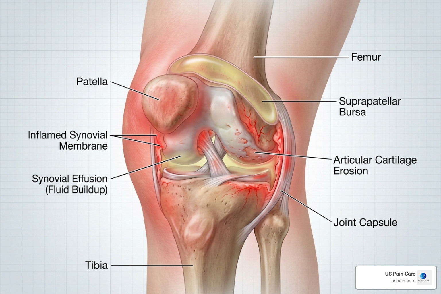 an inflamed knee joint showing redness and internal swelling - anti-inflammatory foods for pain