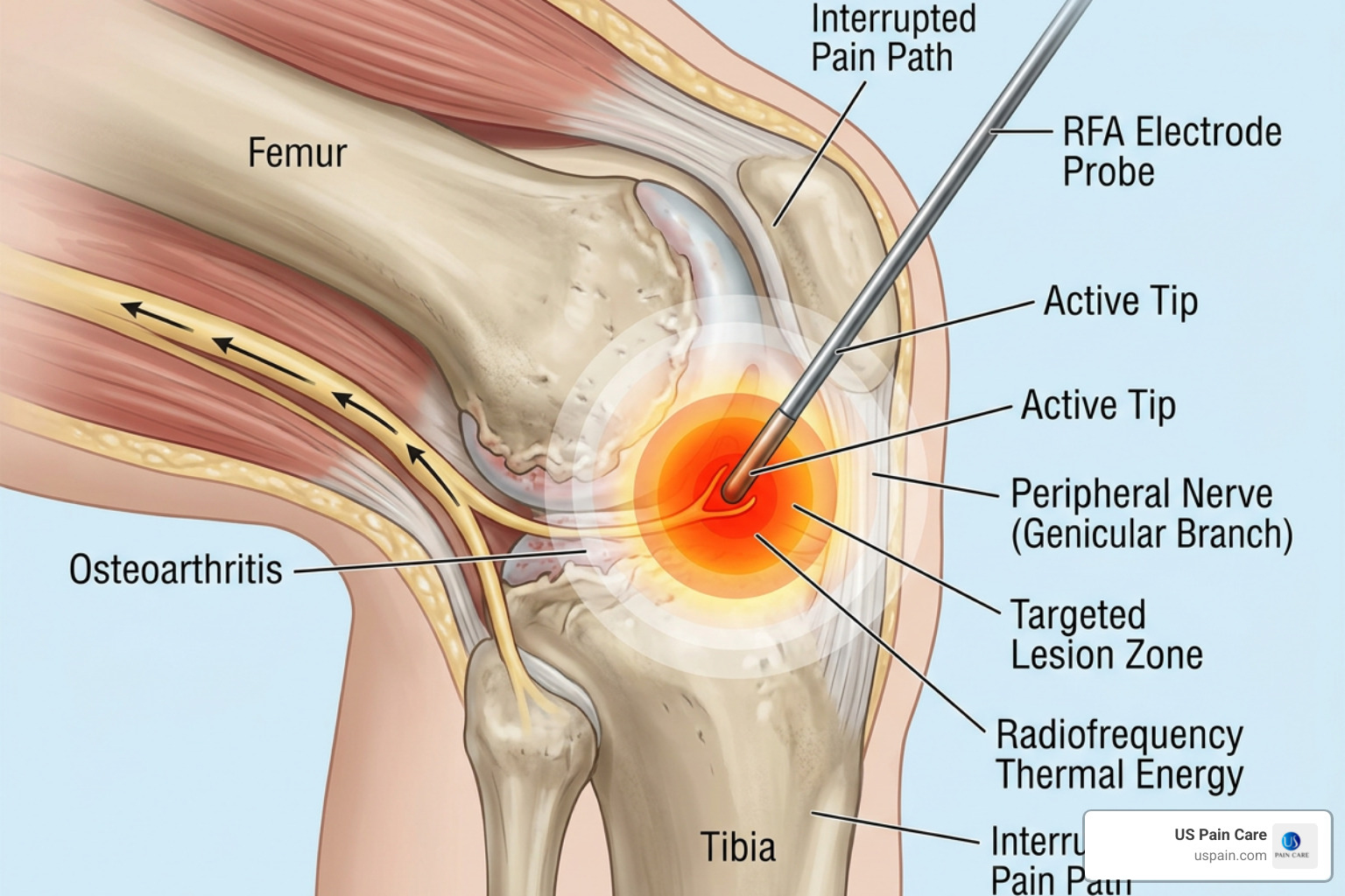 Radiofrequency waves targeting a specific nerve to create a heat lesion - rfa for arthritis pain