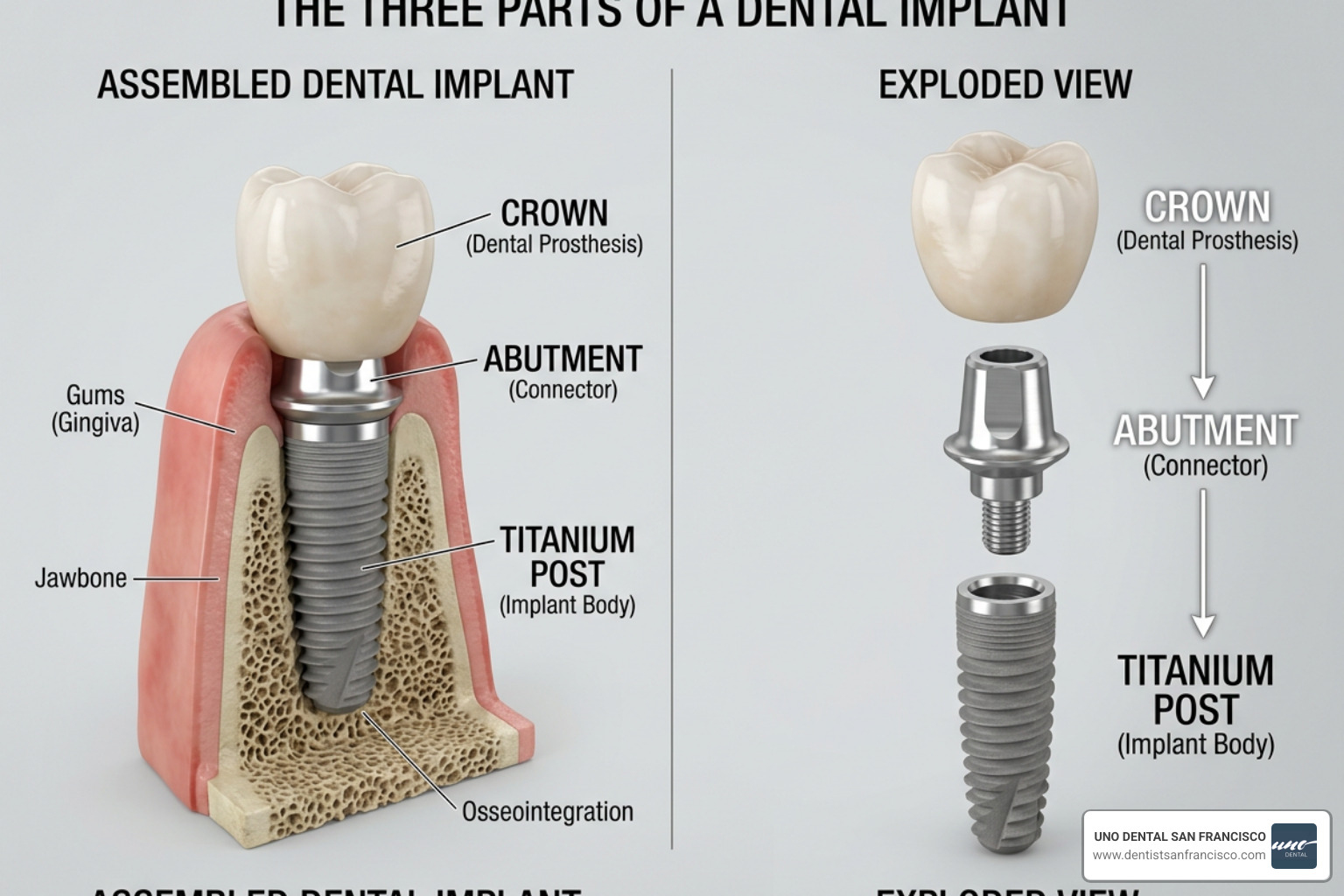 the three parts of a dental implant: post, abutment, and crown - Free implant consultation the three parts of a dental implant: post, abutment, and crown - Free implant consultation