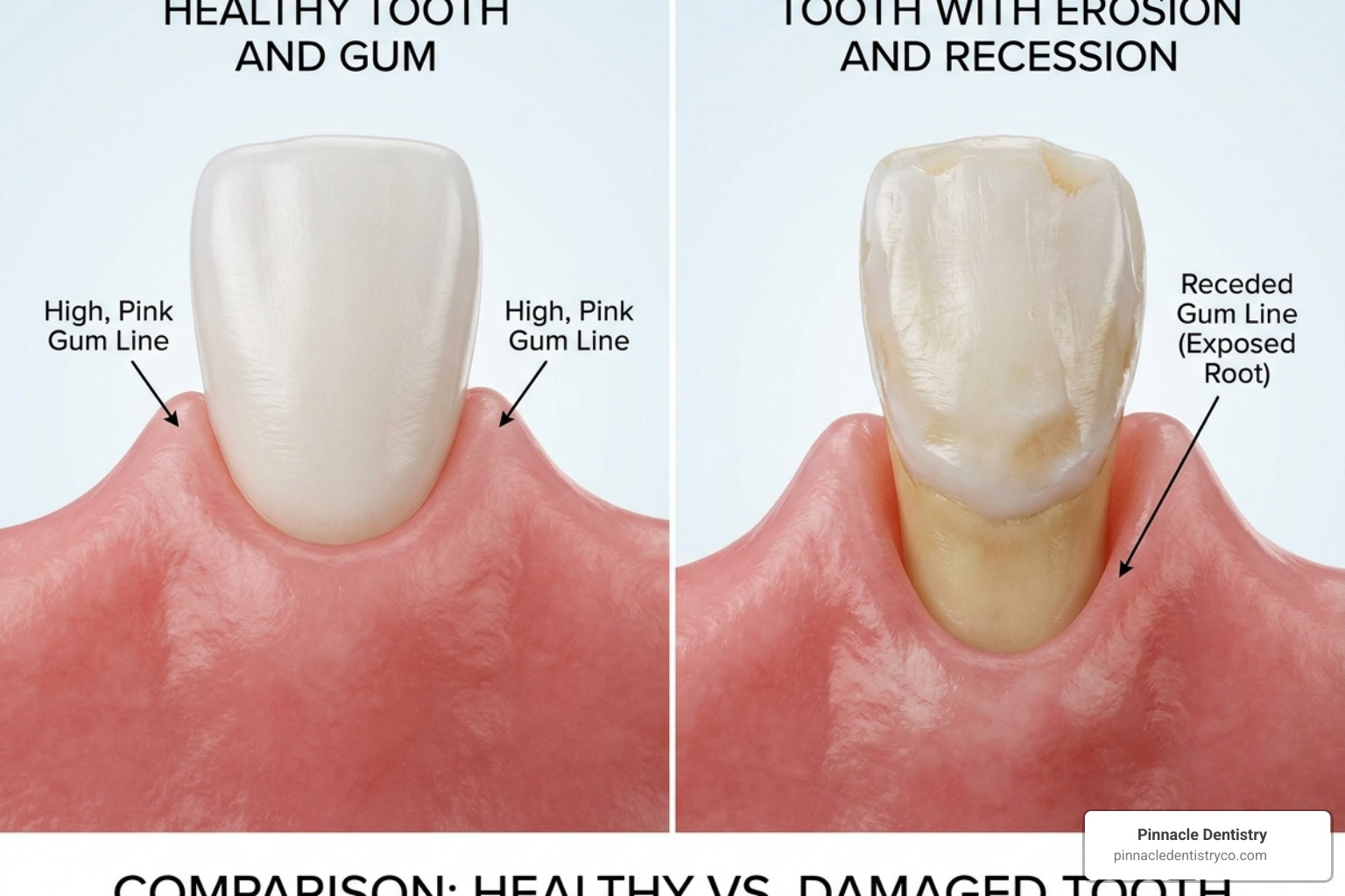 Comparison of healthy tooth enamel versus enamel erosion and gum recession - desensitizing toothpaste for tooth sensitivity