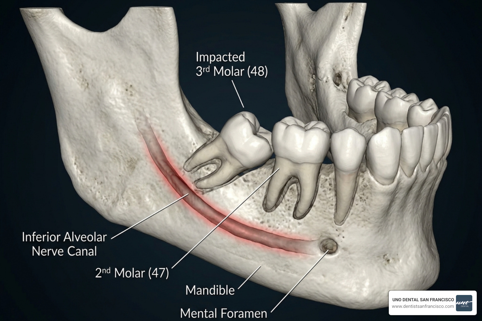 3D CBCT scan showing impacted wisdom teeth and nerve proximity - tooth extraction Bay Area 3D CBCT scan showing impacted wisdom teeth and nerve proximity - tooth extraction Bay Area