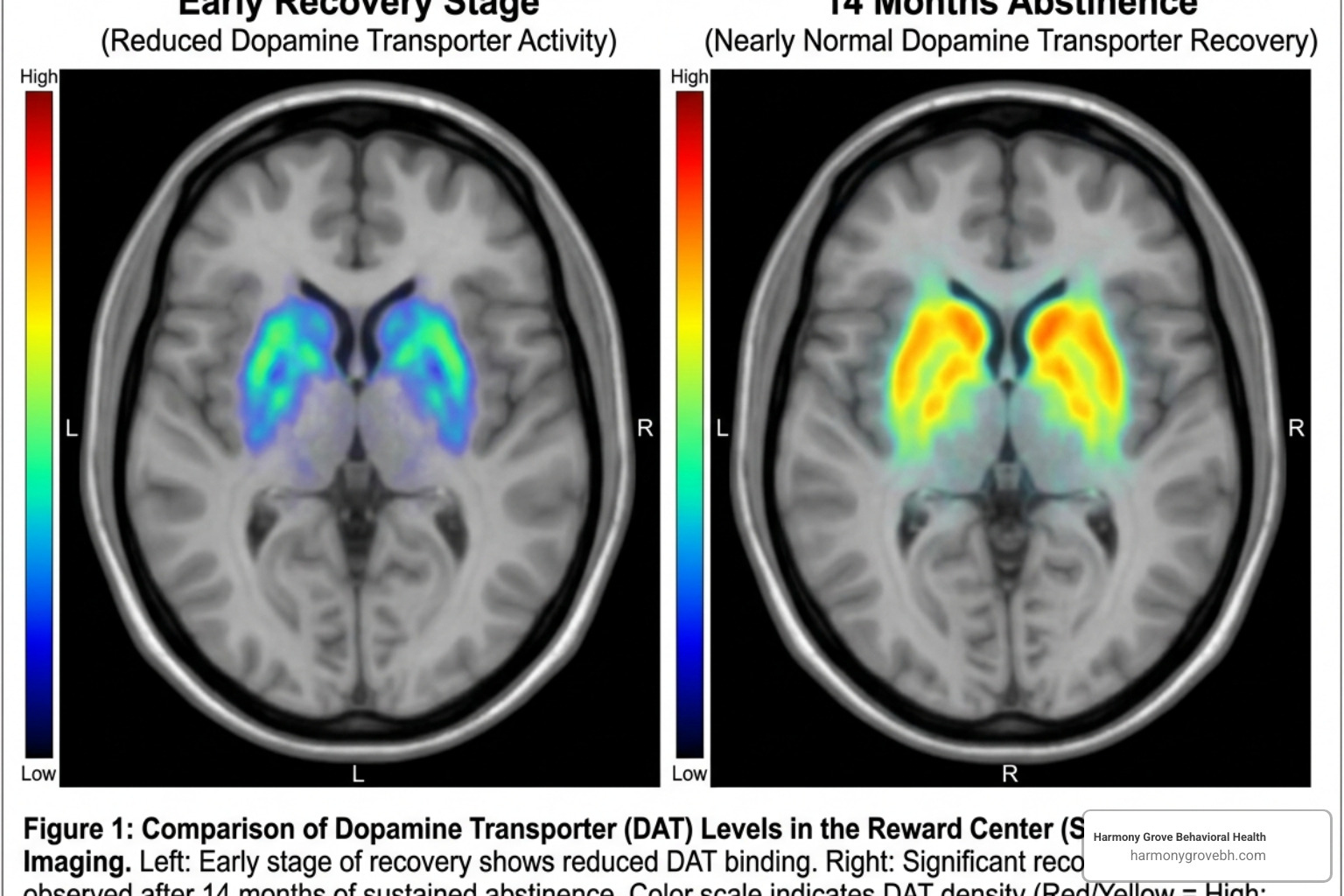 Brain scan showing dopamine transporter recovery over 14 months - addiction recovery Brain scan showing dopamine transporter recovery over 14 months - addiction recovery