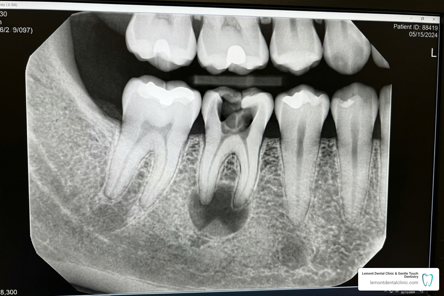 Digital X-ray showing an infected tooth requiring a root canal - root canal cost Romeoville