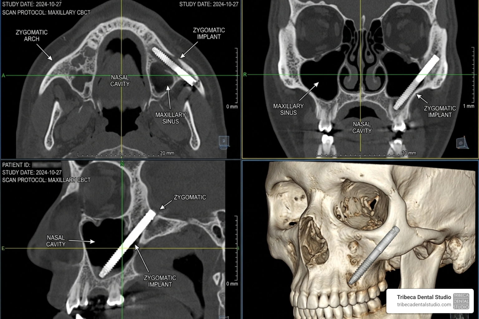 3D CBCT scan showing zygomatic implant placement in the cheekbone - zygomatic implants pros and cons