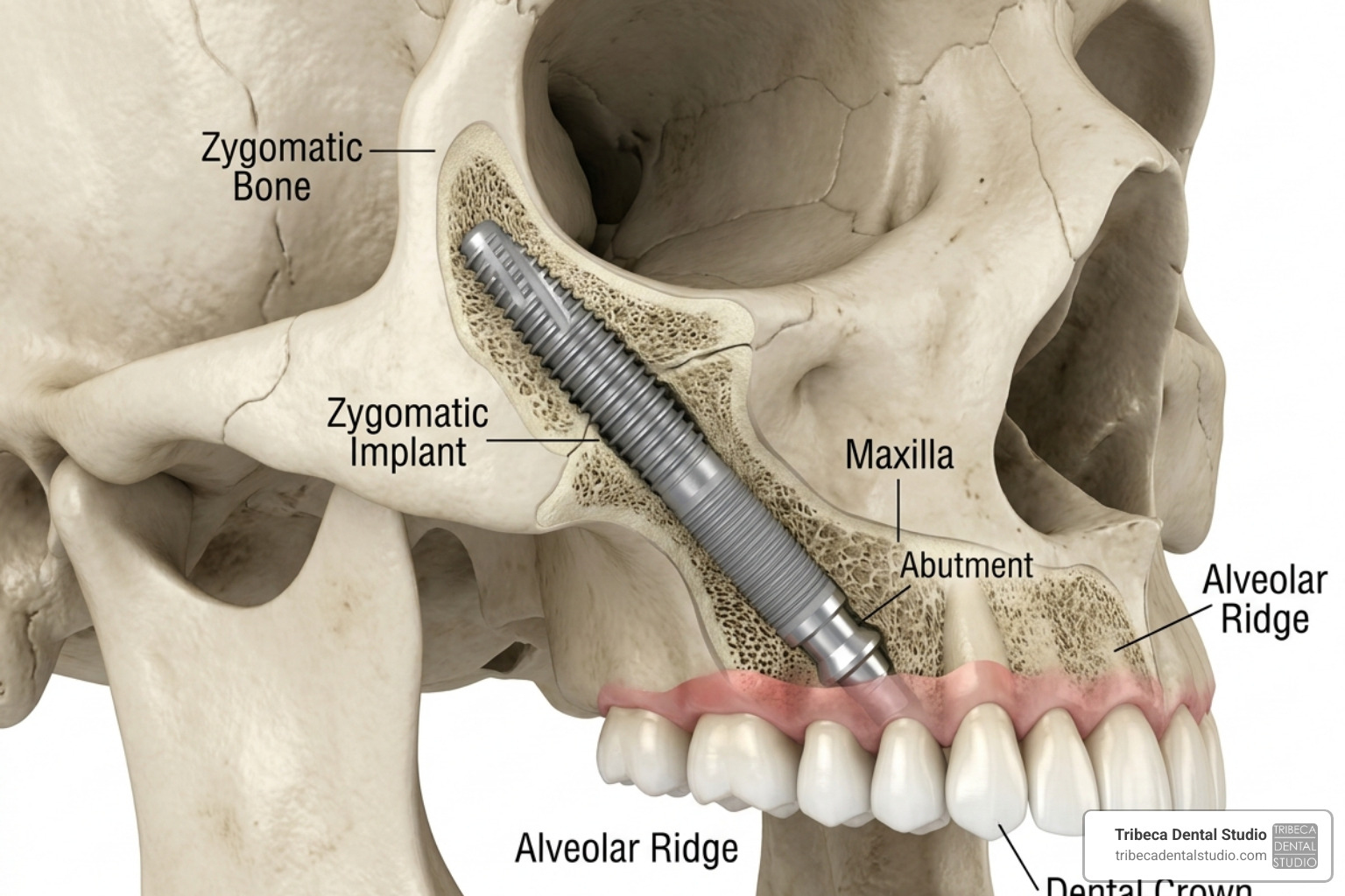 Model of a zygomatic implant anchored in the cheekbone - zygomatic dental implants cost Model of a zygomatic implant anchored in the cheekbone - zygomatic dental implants cost