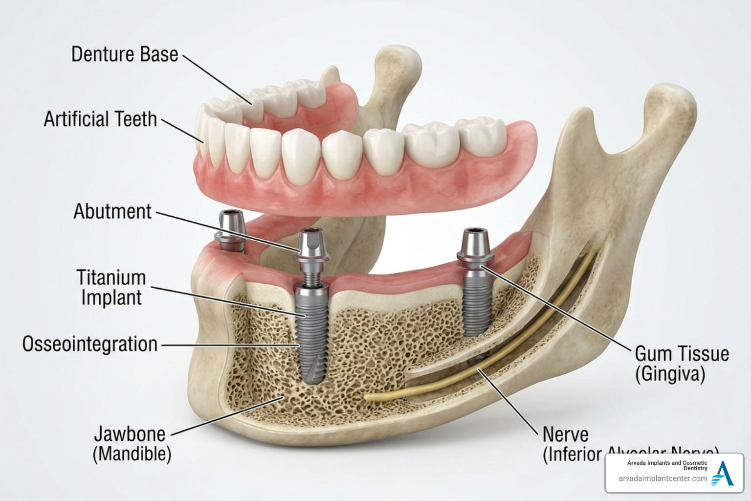 An implant-supported denture showing how it anchors to the jawbone - Fix loose dentures