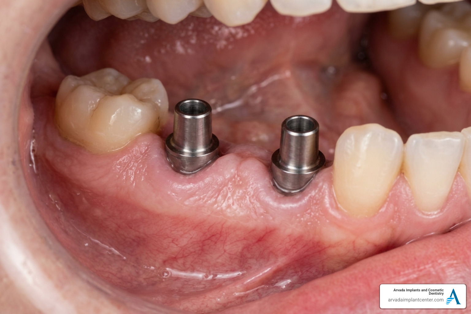healthy gum tissue healing around dental implants after 4 weeks - all on 4 recovery time