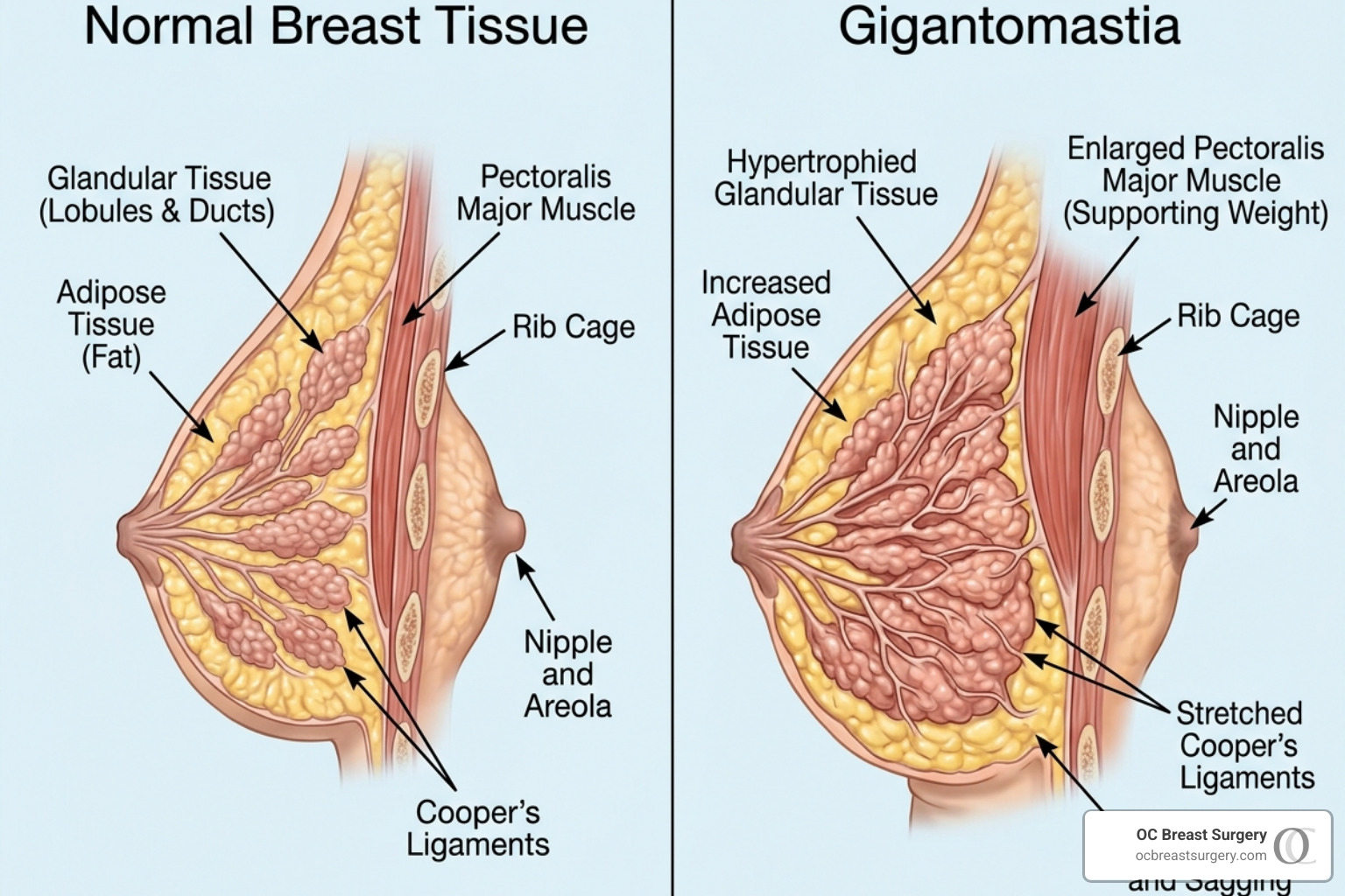 medical diagram of breast tissue and anatomy for gigantomastia - big large natural breasts